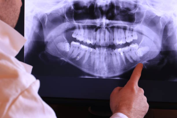 Best Emergency Wisdom Teeth Removal in Atwood, IL